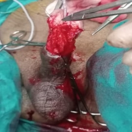 Hypospadias img1