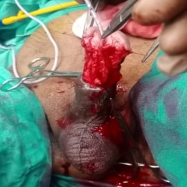 Hypospadias img2