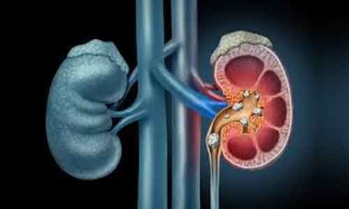 Kidney Stone Treatment in Secunderabad, Hyderabad