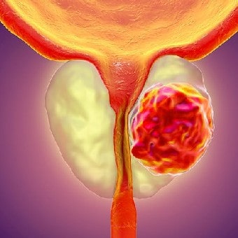 Prostate Cancer