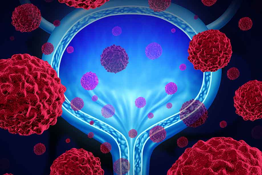Bladder Cancer Treatment in Secunderabad, Hyderabad