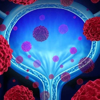Bladder Cancer