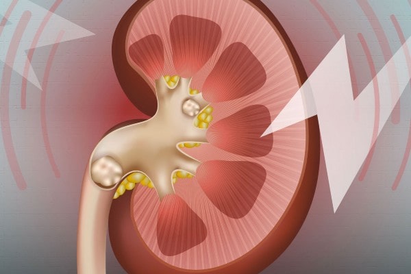 Debunking The Most Common Kidney Stone Myths