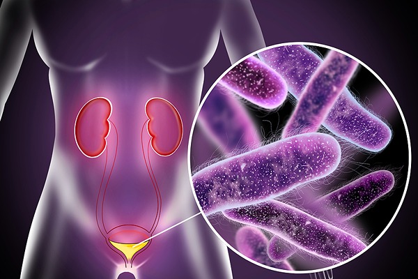 Preventing, treating, and getting help from a specialist for urinary tract infections (UTIs)