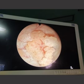 tumor img1