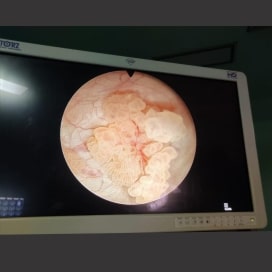tumor img2