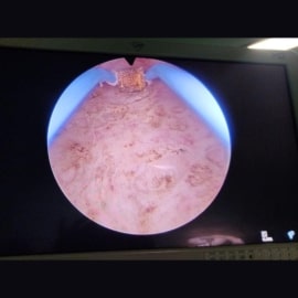 tumor img3