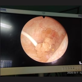 tumor img4