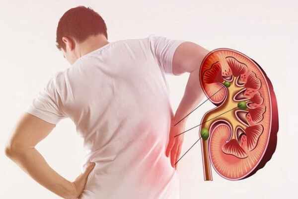 Understanding Kidney Stones: Causes, Symptoms, and Advanced Treatment Options by Dr. Kalyan Kumar A.V