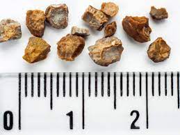 What role does diet have in Kidney Stones?